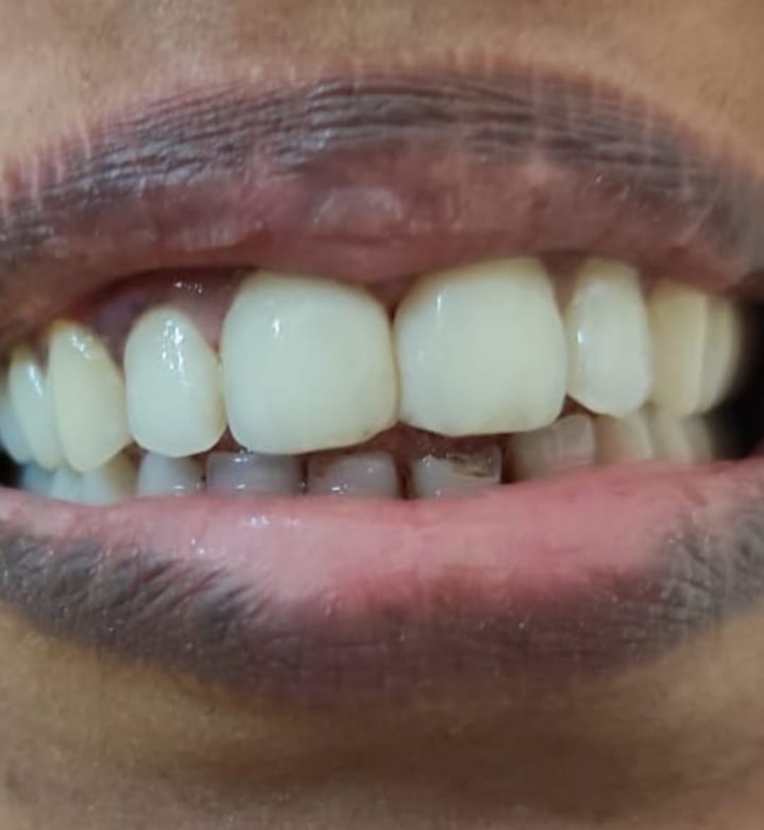 The same patient's smile after treatment, with even, brighter and well-aligned front teeth