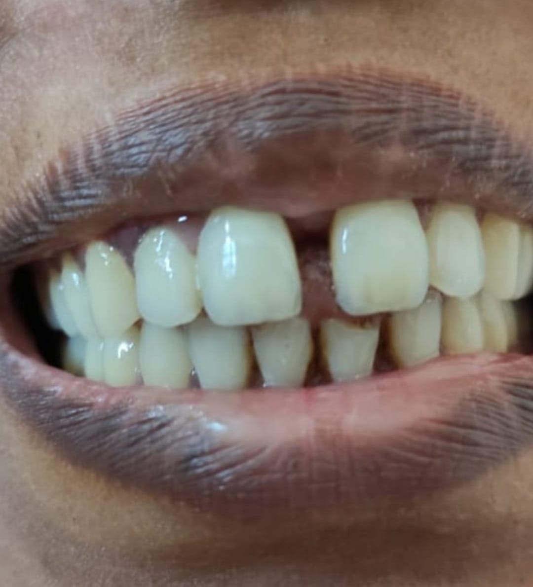 Patient's upper front teeth before treatment, showing discolouration, spacing and worn edges
